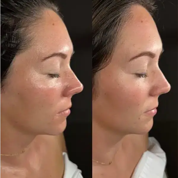 faciales diamond peel