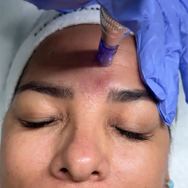 faciales micronedling