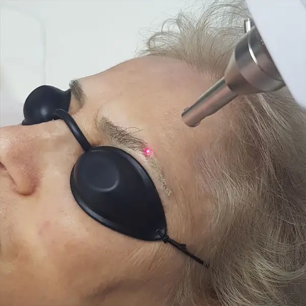 laser eliminacion tatuaje