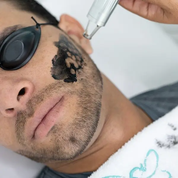 laser holliwood peel